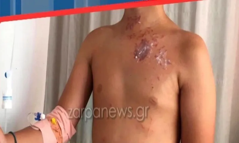 Κρήτη: Δείτε τι έπαθε 9χρονος που τον τσίμπησε θαλάσσια ανεμώνη (vid)