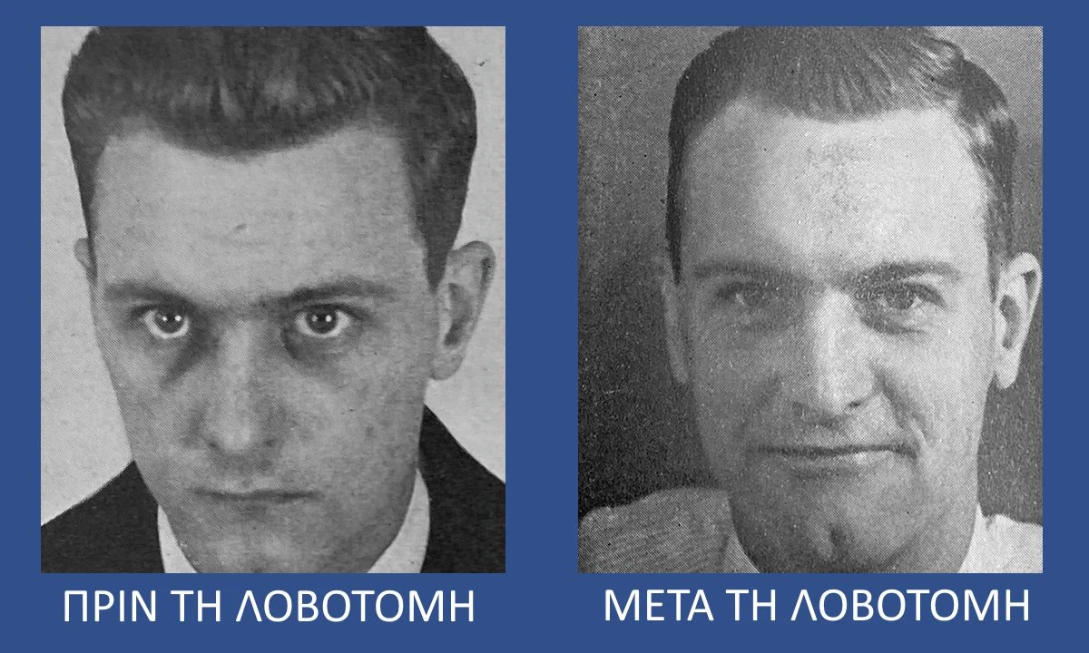 λοβοτομή πριν και μετά