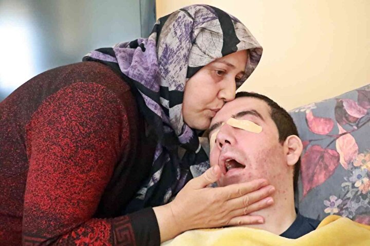Τουρκία: Απίστευτο δράμα ζει 30χρονος ο οποίος έχει προσβληθεί από σπάνια νόσο που τον αναγκάζει να μην μπορεί να κλείσει τα βλέφαρά του!